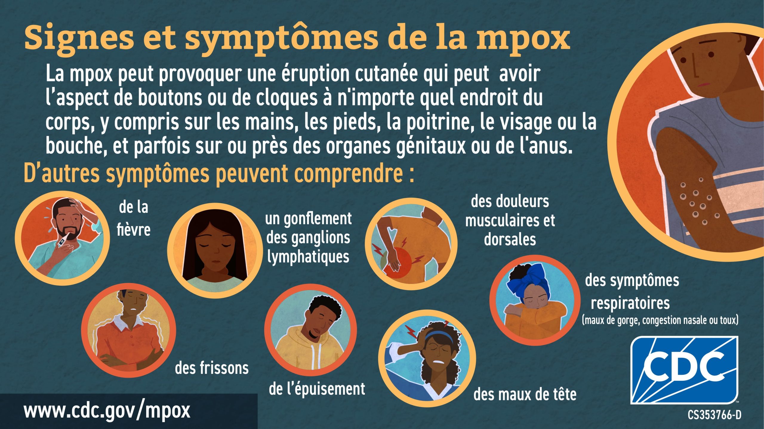 Infographic: Signes et symptômes de la monkeypox