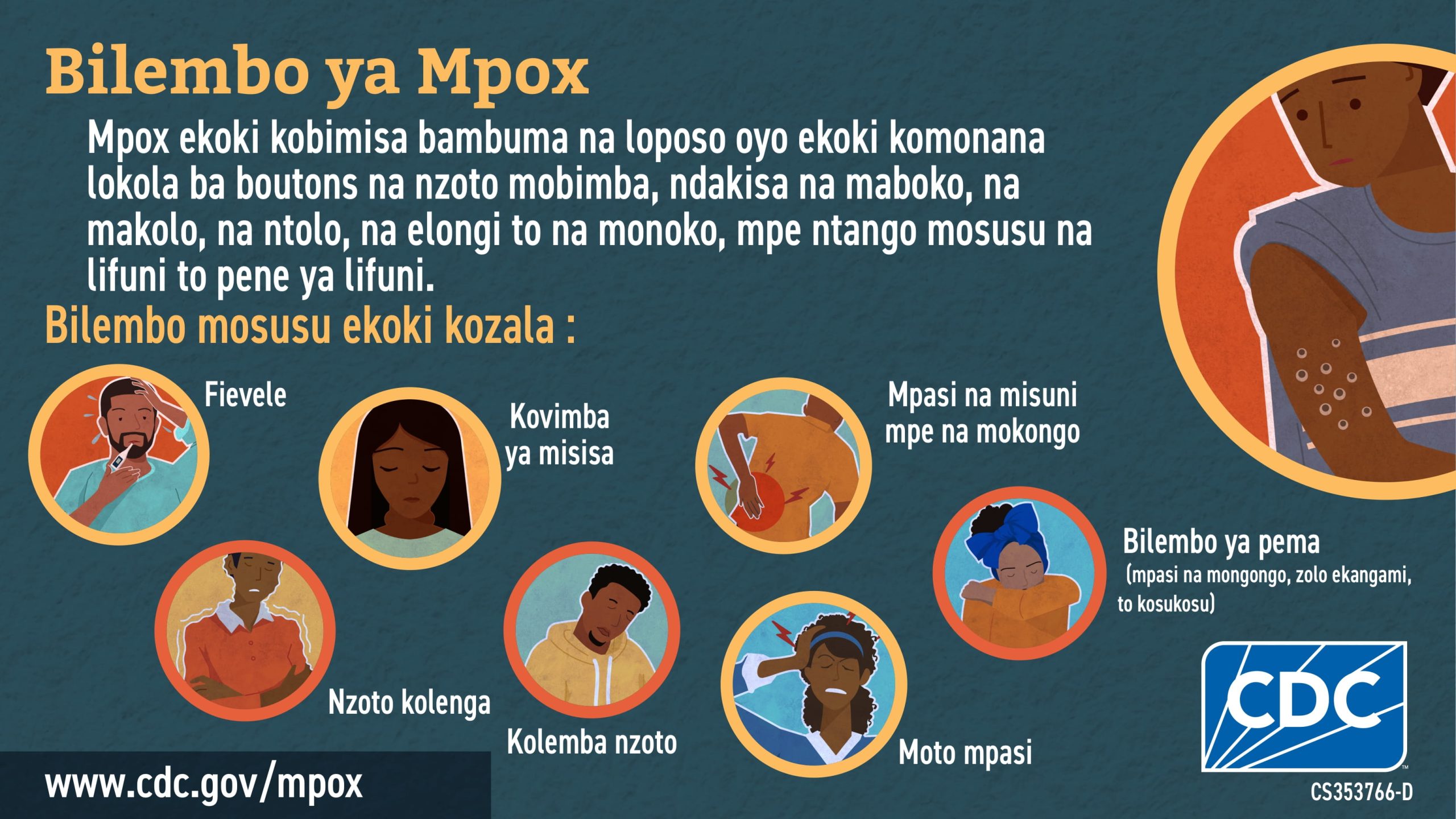 Infographic: Bilembo ya Monkeypox