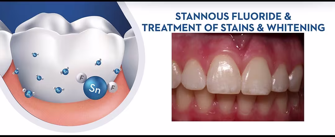 Stannous Fluoride  and Treatment of Stains and Whitening