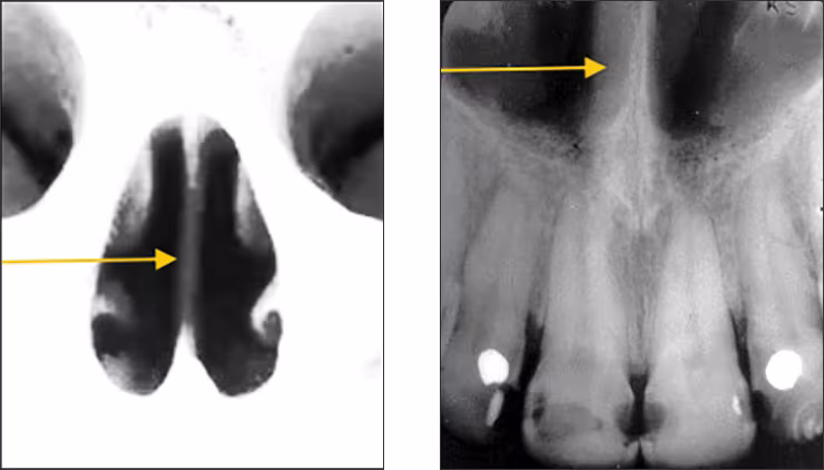Maxillary Anterior Landmarks - Figure 2