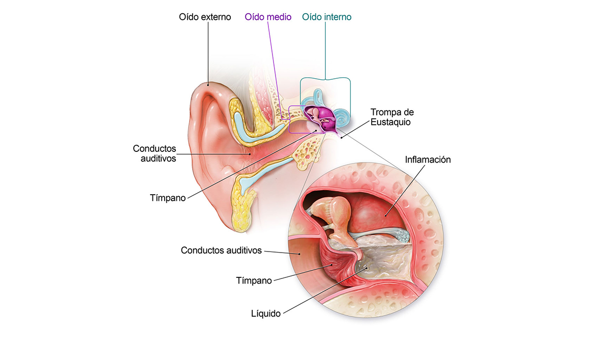 Diagrama de la anatom&iacute;a del o&iacute;do que muestra d&oacute;nde se acumula el l&iacute;quido en el o&iacute;do medio y d&oacute;nde ejerce presi&oacute;n.