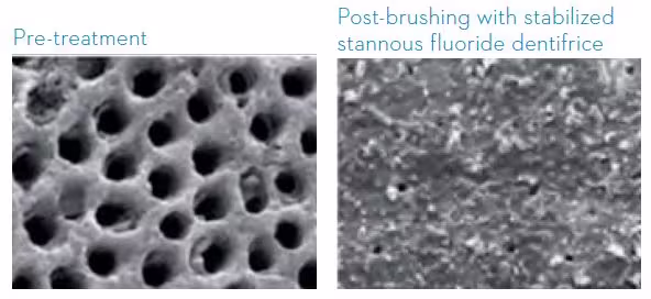 Pre-and post-brushing SEMs