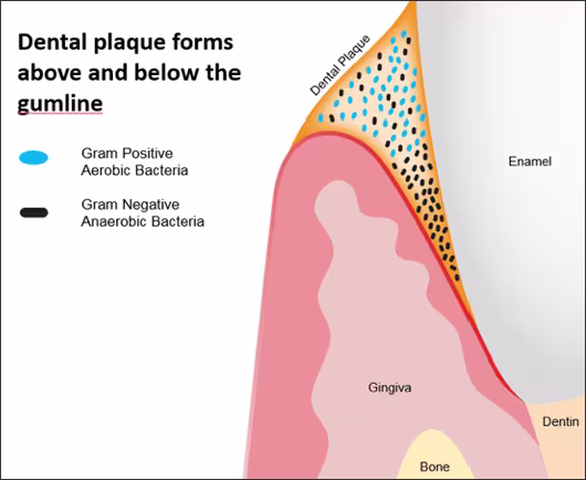 Illustration showing dental plaque forms above the gumline and in the gingival sulcus. 