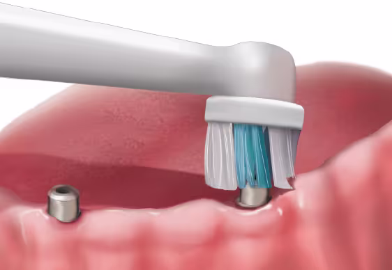 Dental implants home