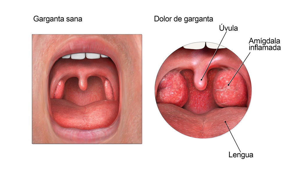 Diagrama de la anatom&iacute;a de la boca que muestra las am&iacute;gdalas inflamadas durante un dolor de garganta.