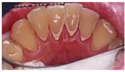 Supragingival calculus