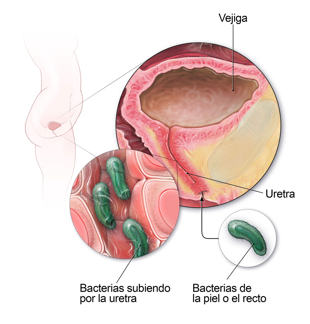Diagrama de v&iacute;as urinarias femeninas infectadas por bacterias.