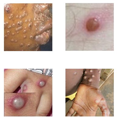 Four photos of monkeypox rashes on different parts of the body