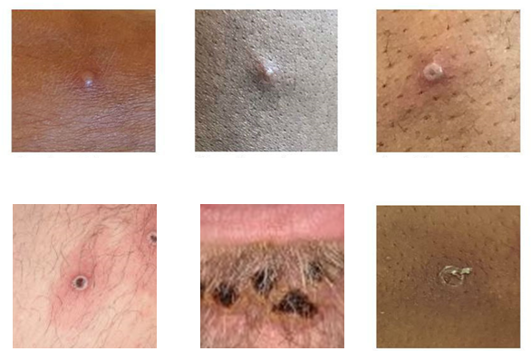Six photos of monkeypox lesions on different skin tones and types.